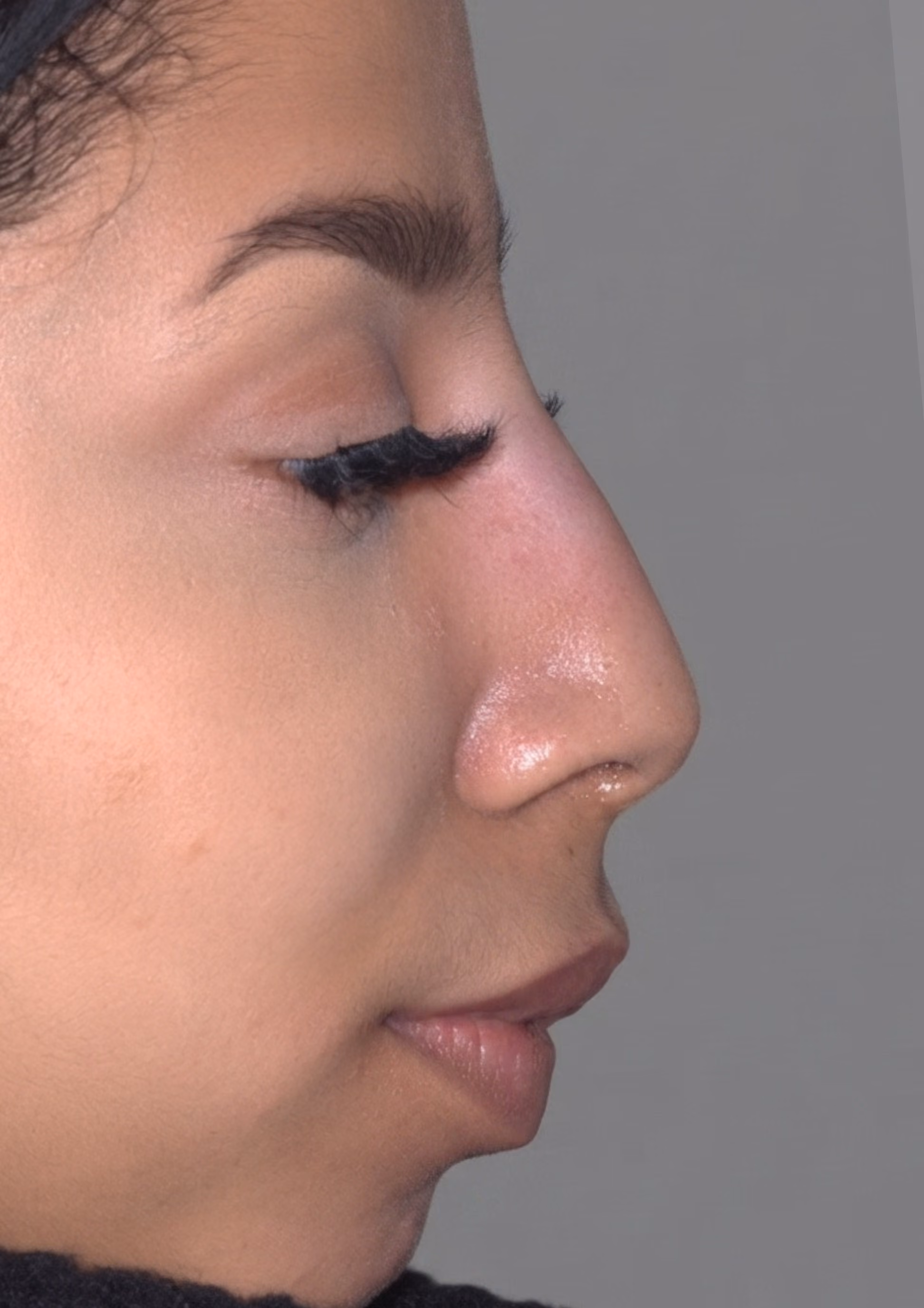 After non-surgical nose reshaping at Dental & Wellness London, Islington