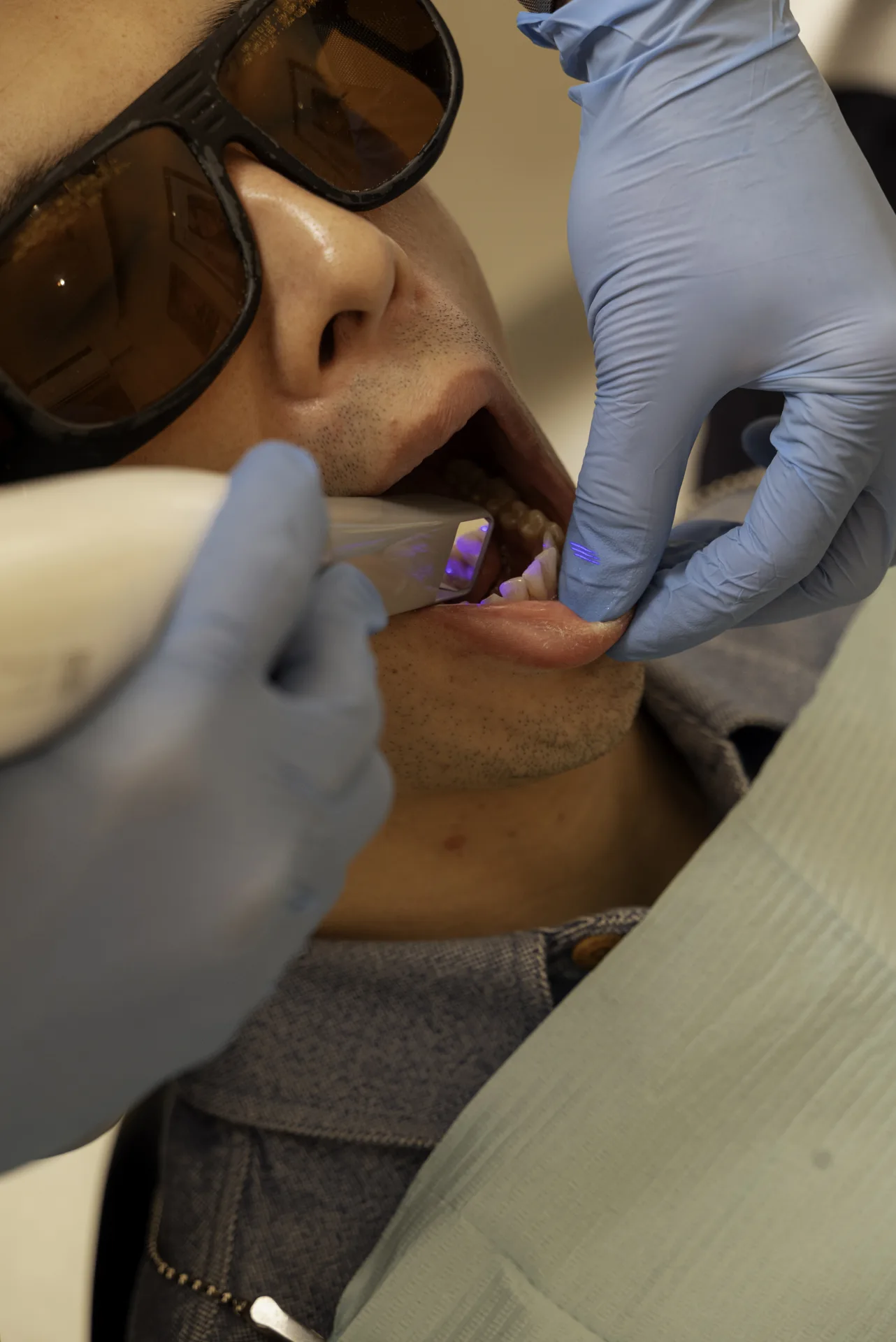 Patient in protective glasses having a curing light used on his front teeth — edge bonding vs full coverage bonding
