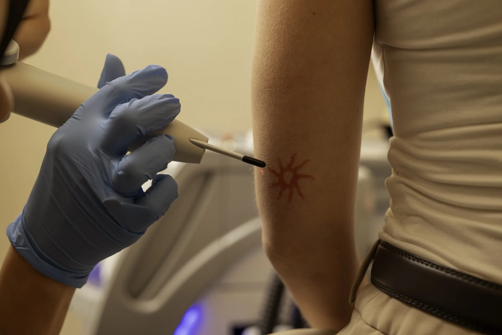 Tattoo removal cost: laser handpiece treating a small tattoo on a forearm