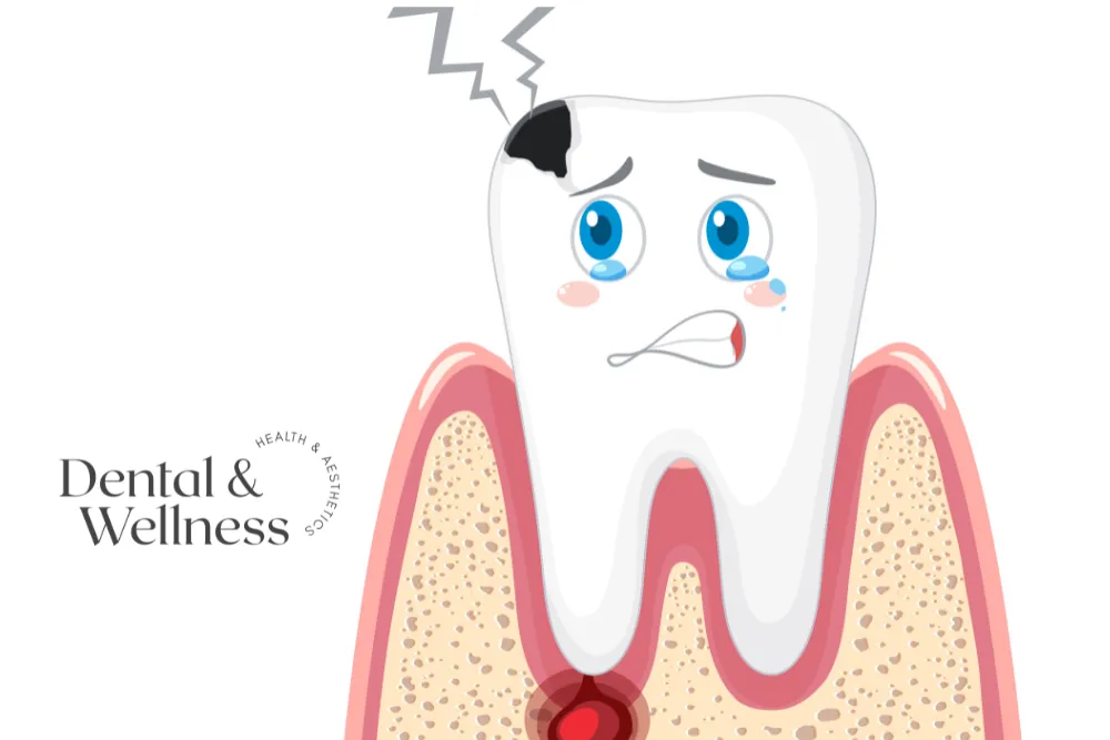 Cartoon of an unhappy tooth with a cavity and an abscess at the root