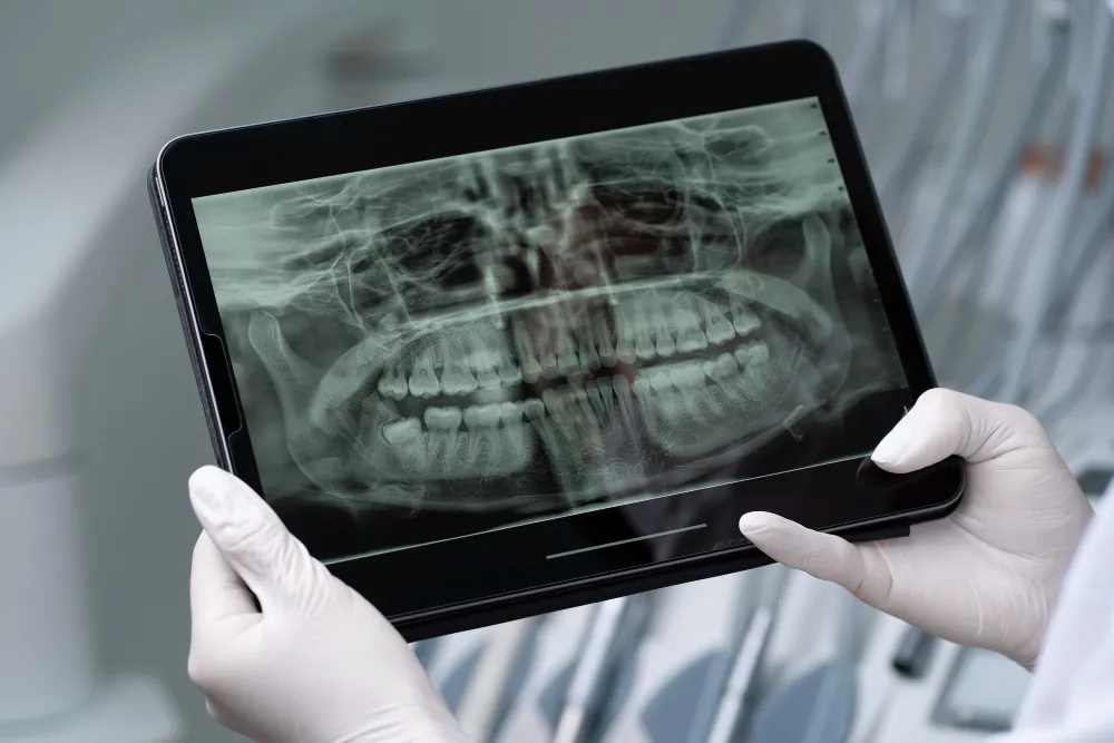 Dental bone graft: gloved hands holding a tablet showing a panoramic dental X-ray