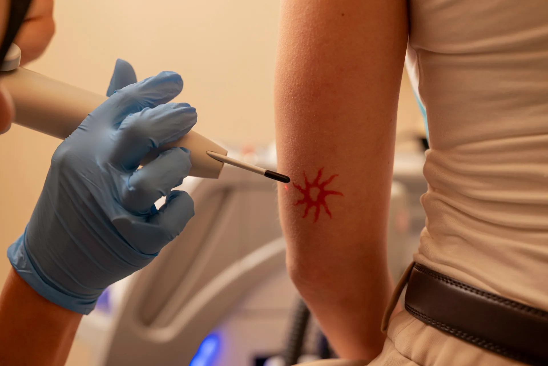Tattoo removal before and after: laser handpiece treating a small tattoo on a forearm