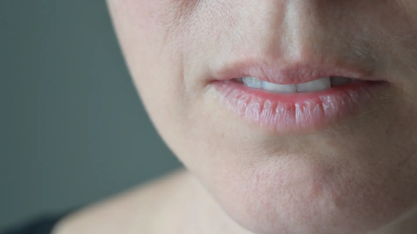 Dry mouth: close-up of dry, slightly parted lips