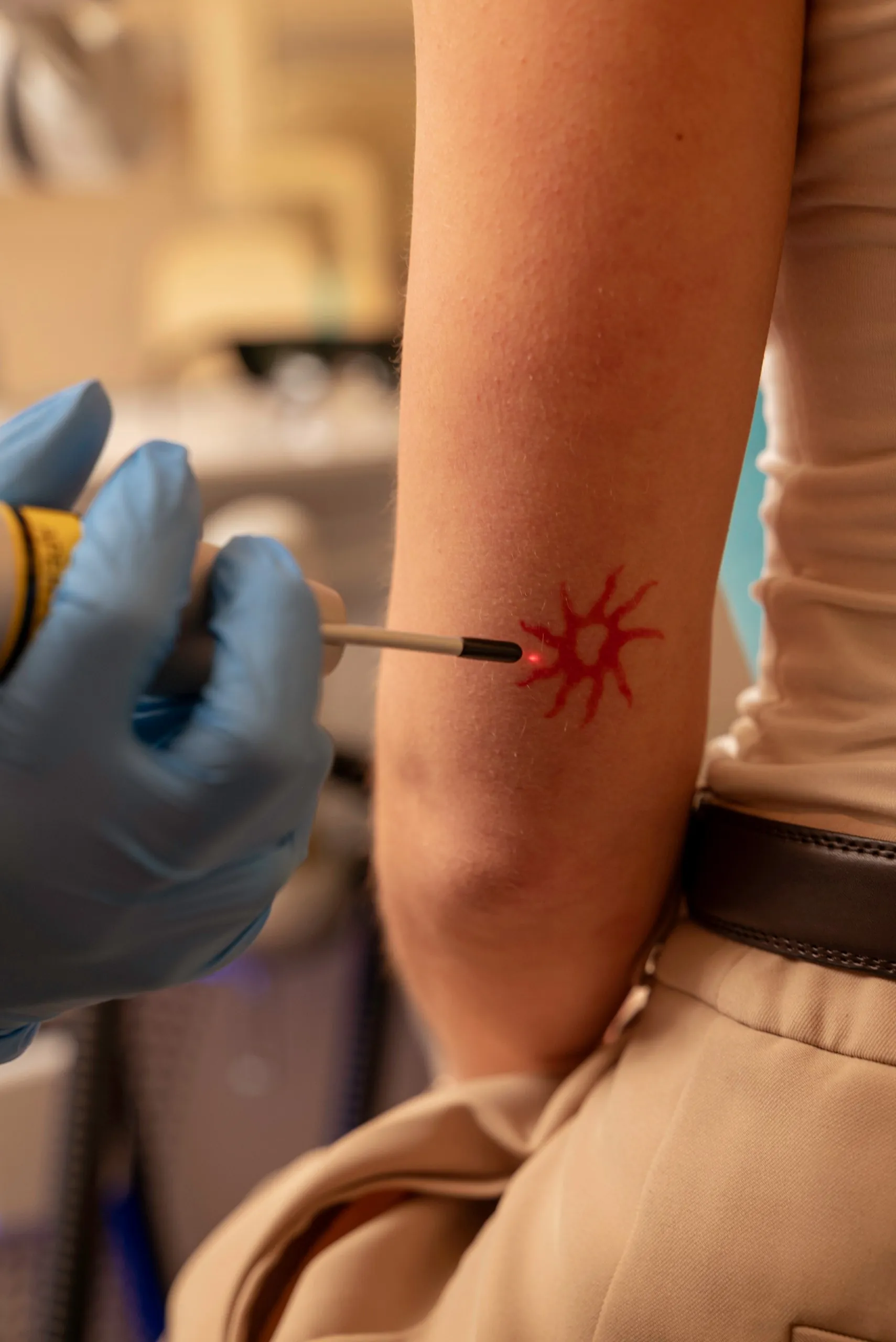 Coloured tattoo removal in Islington, London: laser handpiece treating a small red tattoo on a forearm