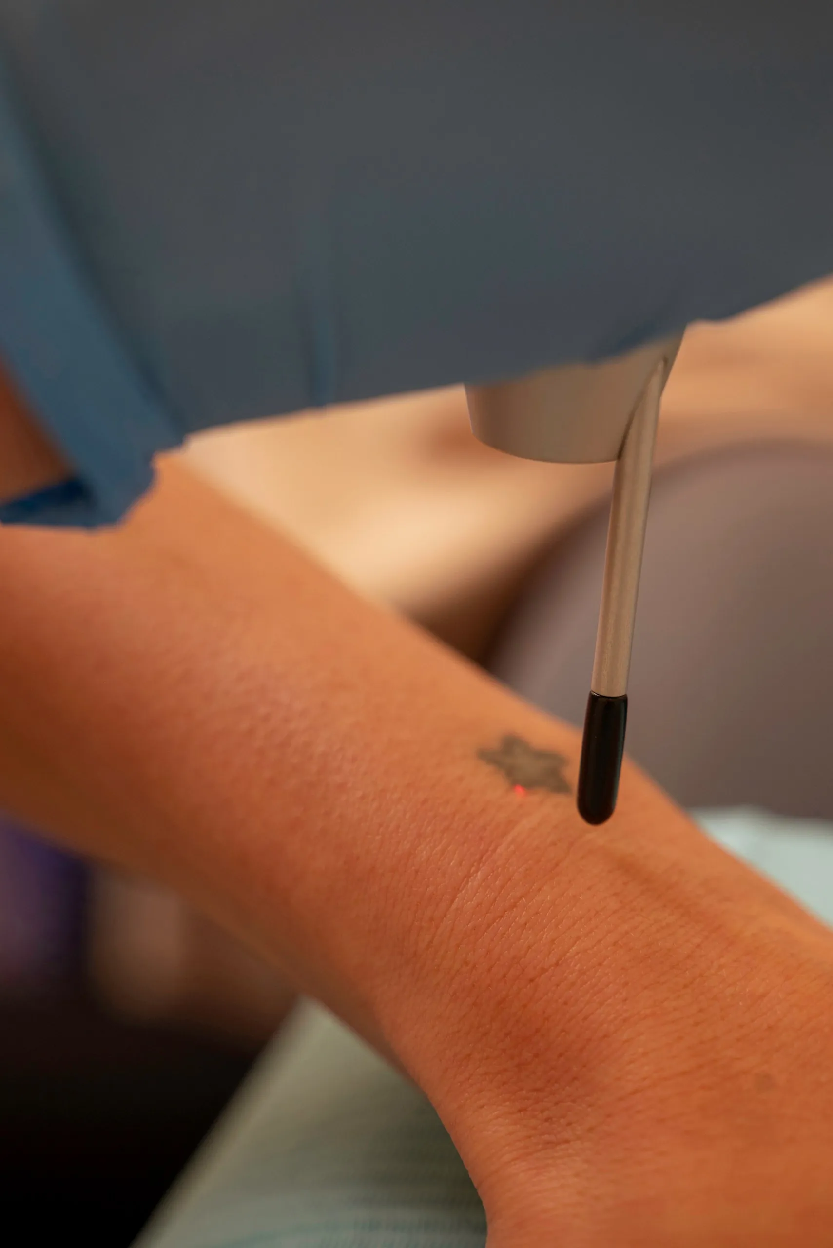 Laser handpiece treating a faded tattoo on a wrist