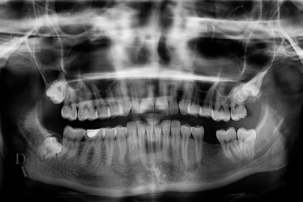 Panoramic dental X-ray showing impacted wisdom teeth
