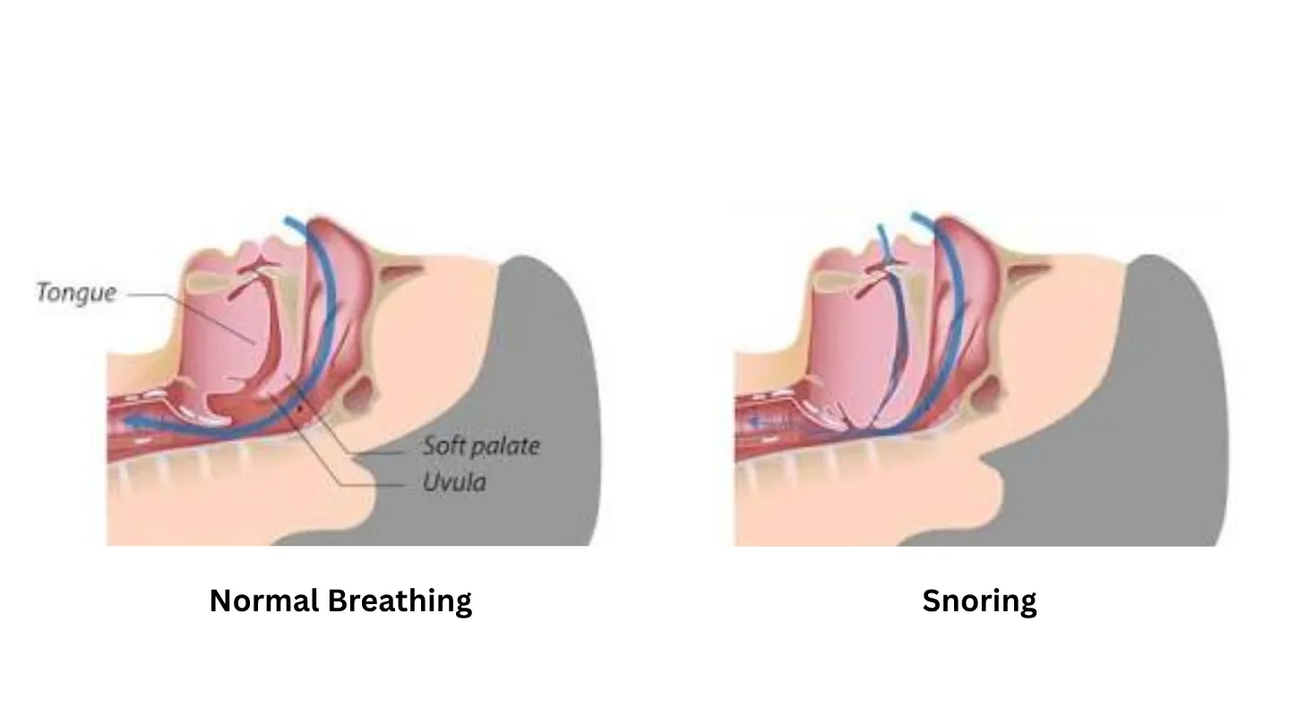 Diagram comparing an open airway during normal breathing with a narrowed airway during snoring