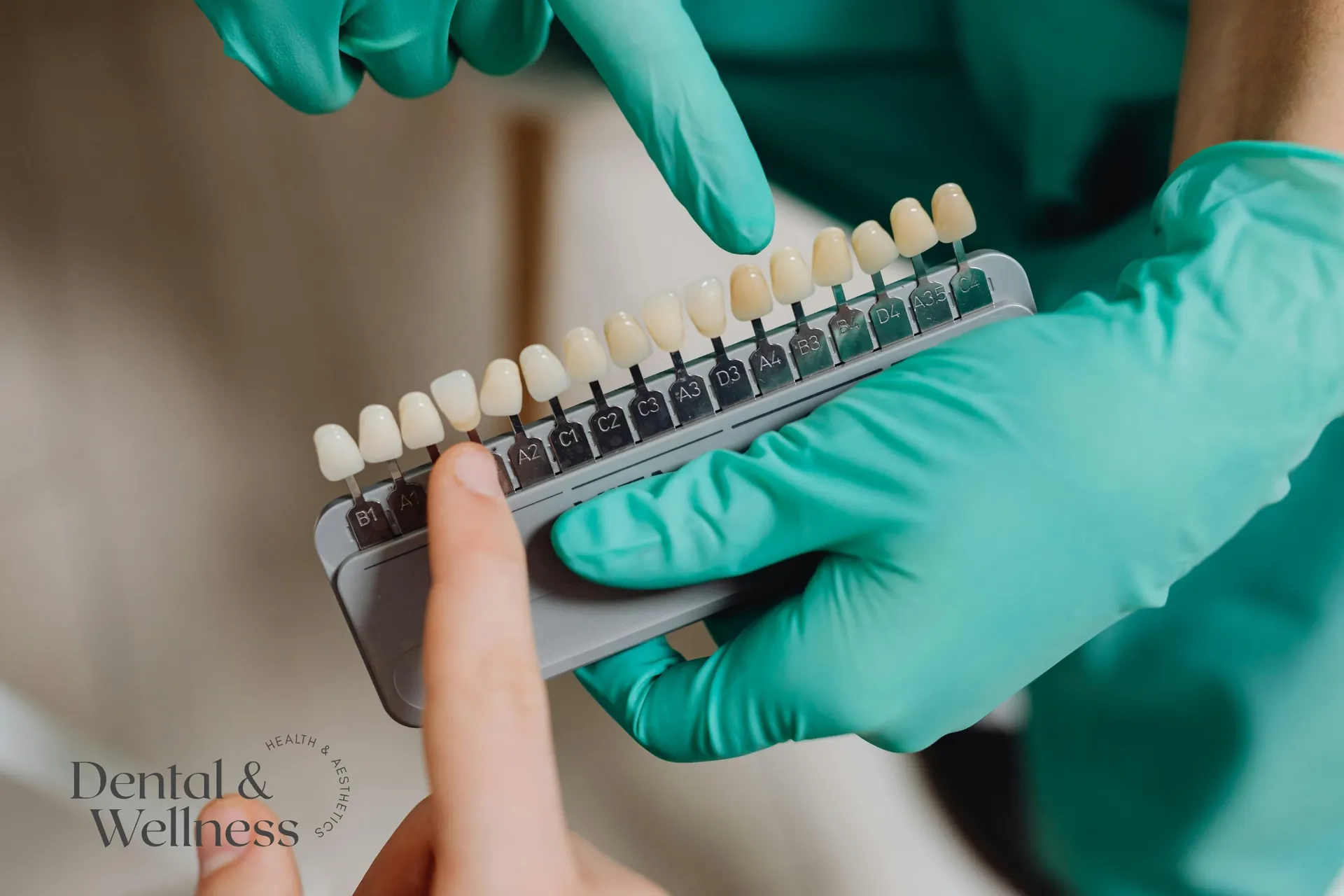 Gloved hand holding a tooth shade guide used to match tooth colour — teeth whitening before and after