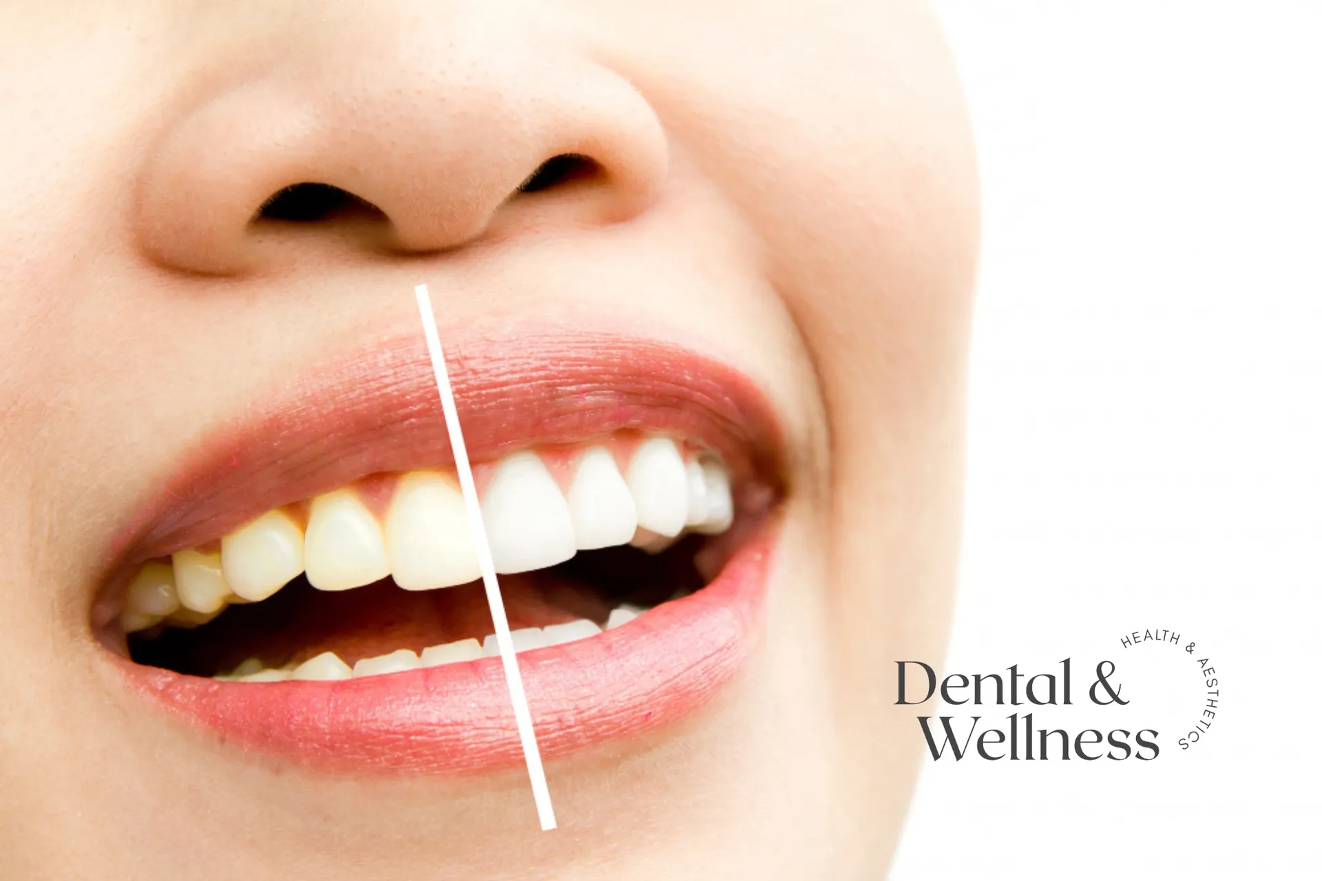 Close-up of a smile split down the middle to compare tooth shade before and after whitening