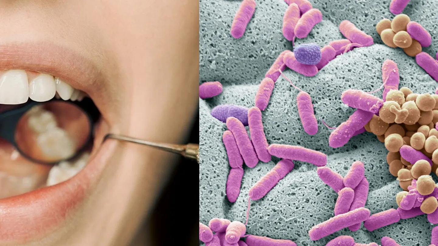 Open mouth being examined beside a magnified image of oral bacteria