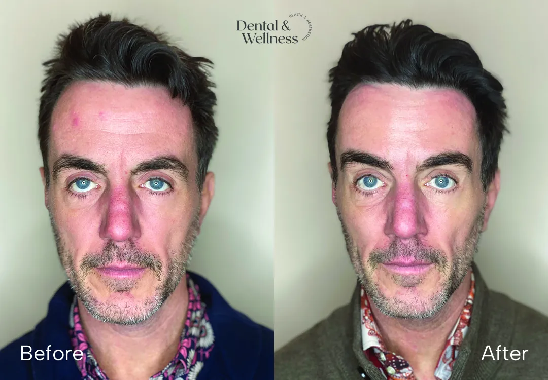 Before and after photos of a man's face showing reduced facial redness and lines