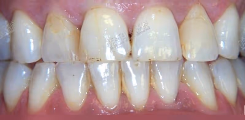 Before veneers at Dental & Wellness London, Islington