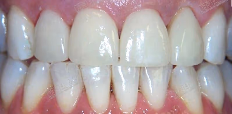 After veneers at Dental & Wellness London, Islington