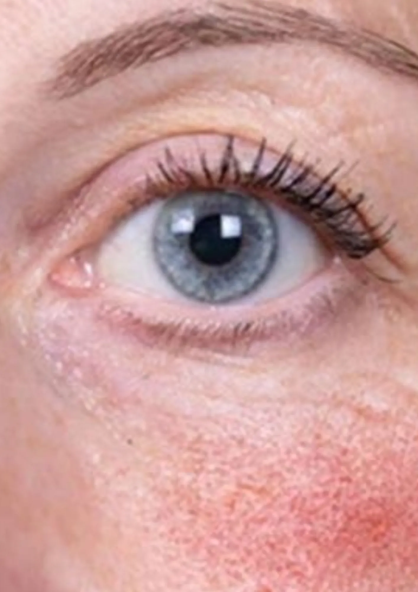 Before skin redness treatment at Dental & Wellness London, Islington