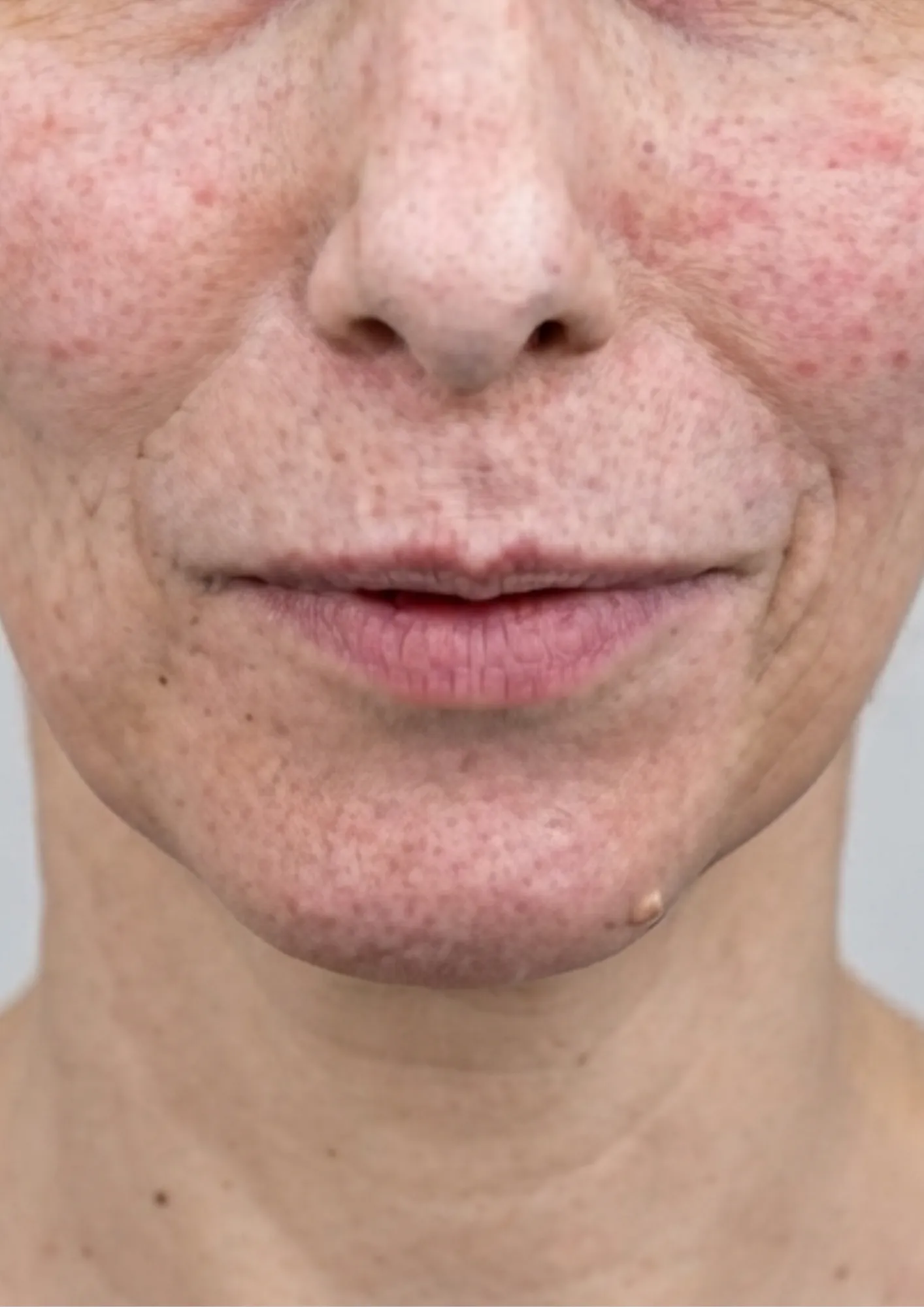 Before skin redness treatment at Dental & Wellness London, Islington