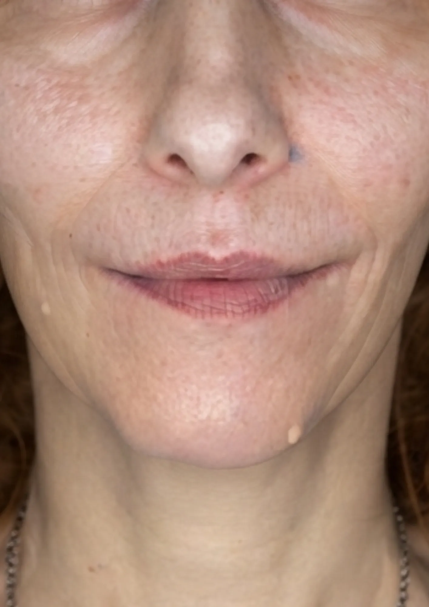 After skin redness treatment at Dental & Wellness London, Islington