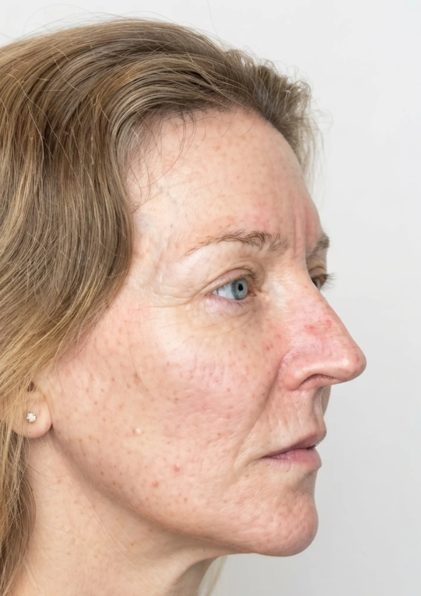 After skin redness treatment at Dental & Wellness London, Islington