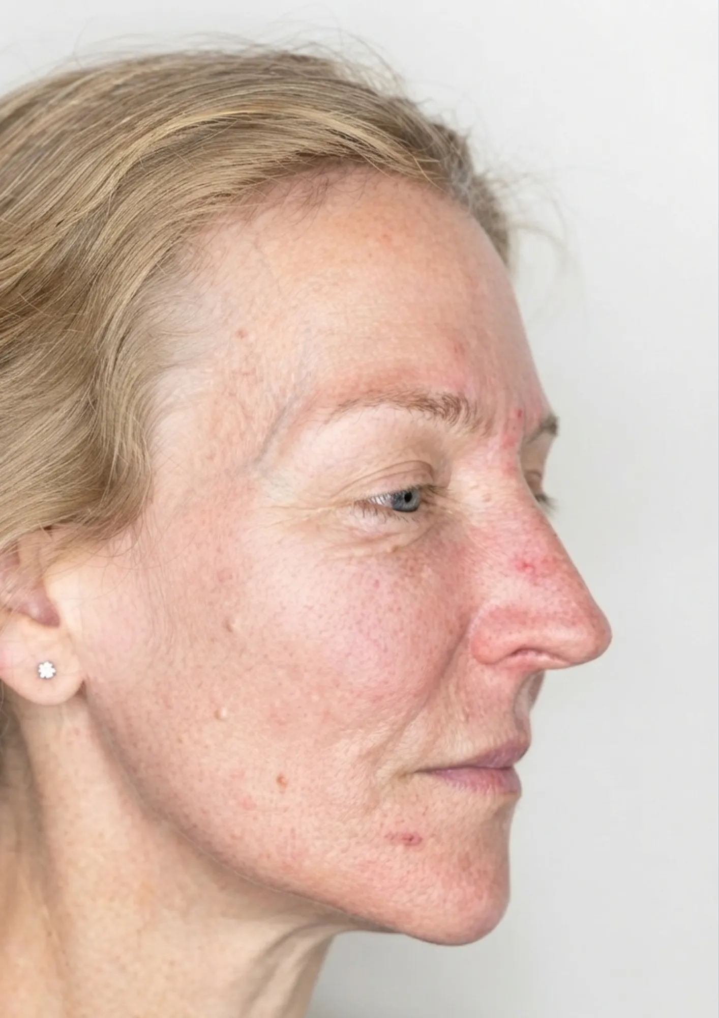 Before skin redness treatment at Dental & Wellness London, Islington