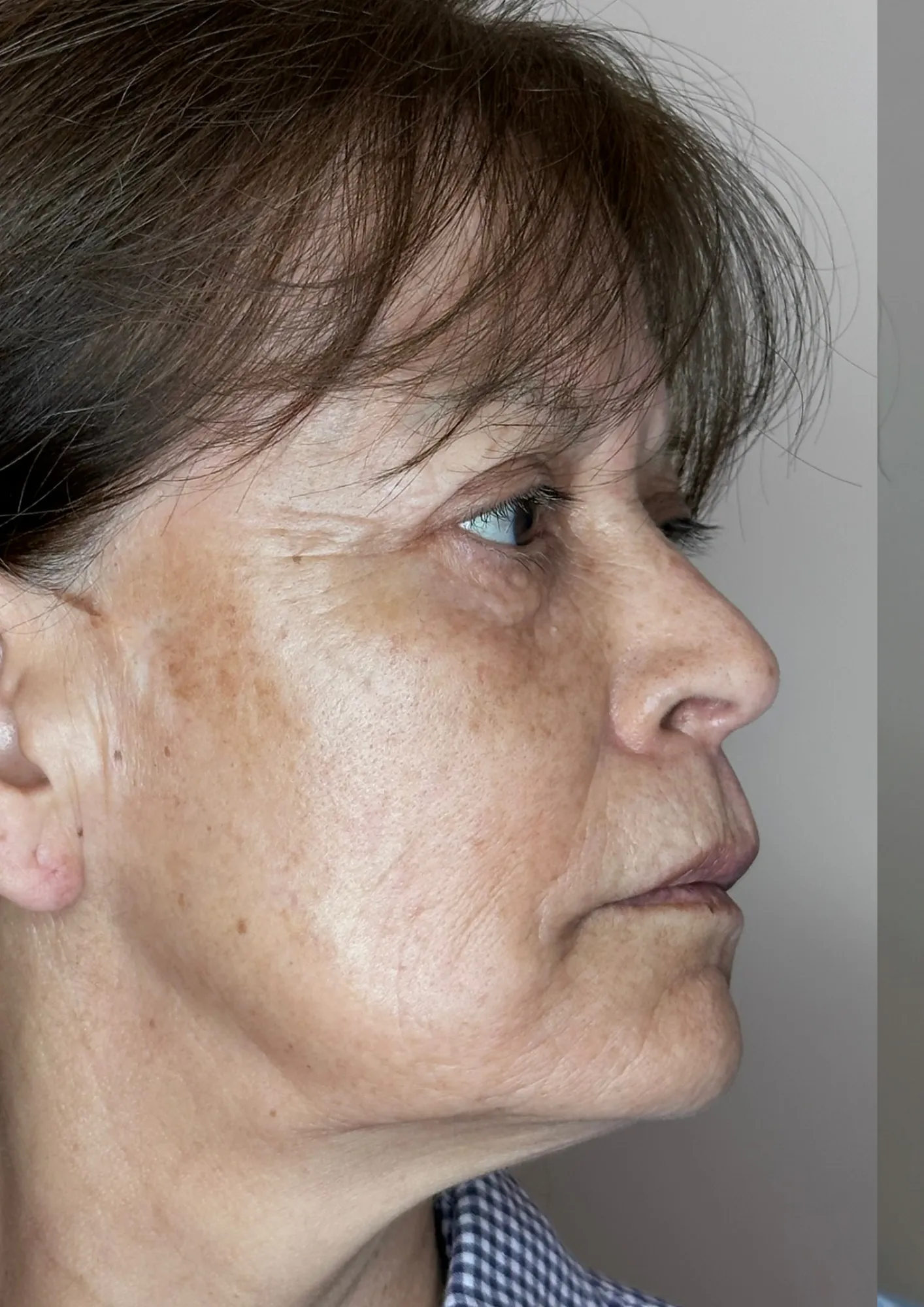 After melasma treatment at Dental & Wellness London, Islington