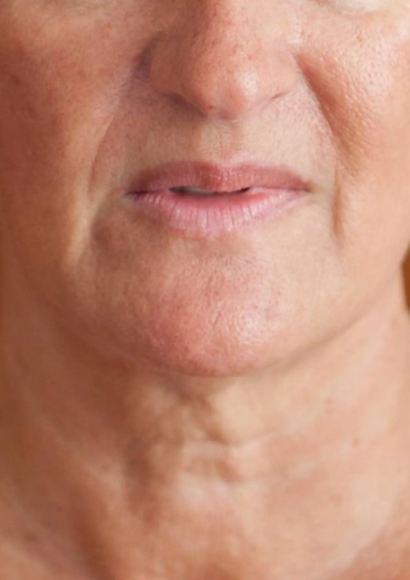 Before skin tightening treatment at Dental & Wellness London, Islington