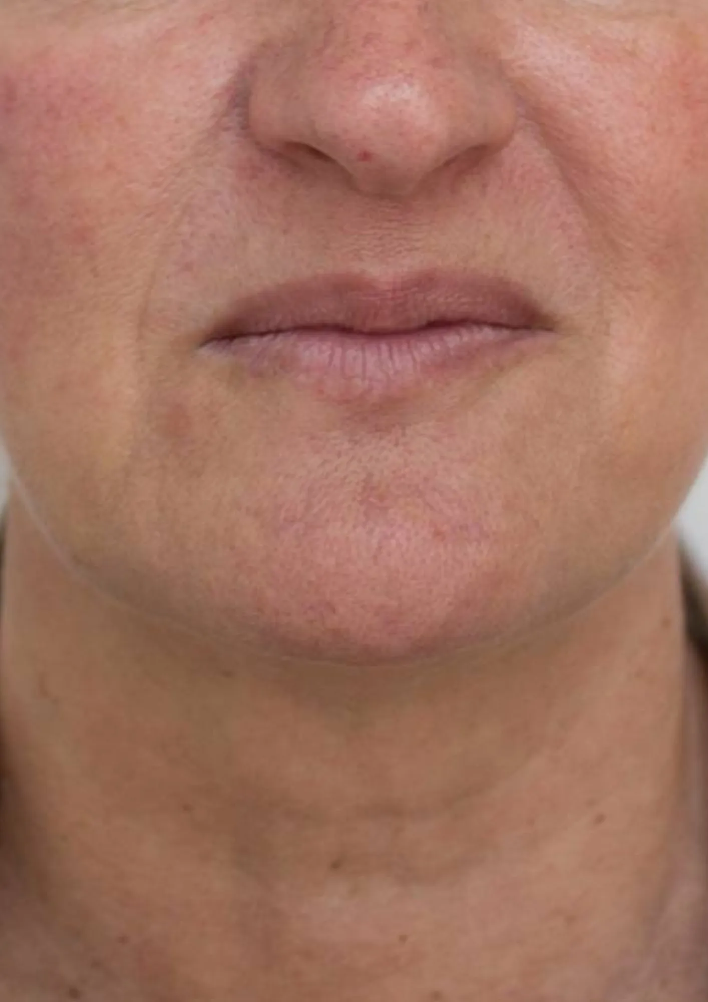 After skin tightening treatment at Dental & Wellness London, Islington