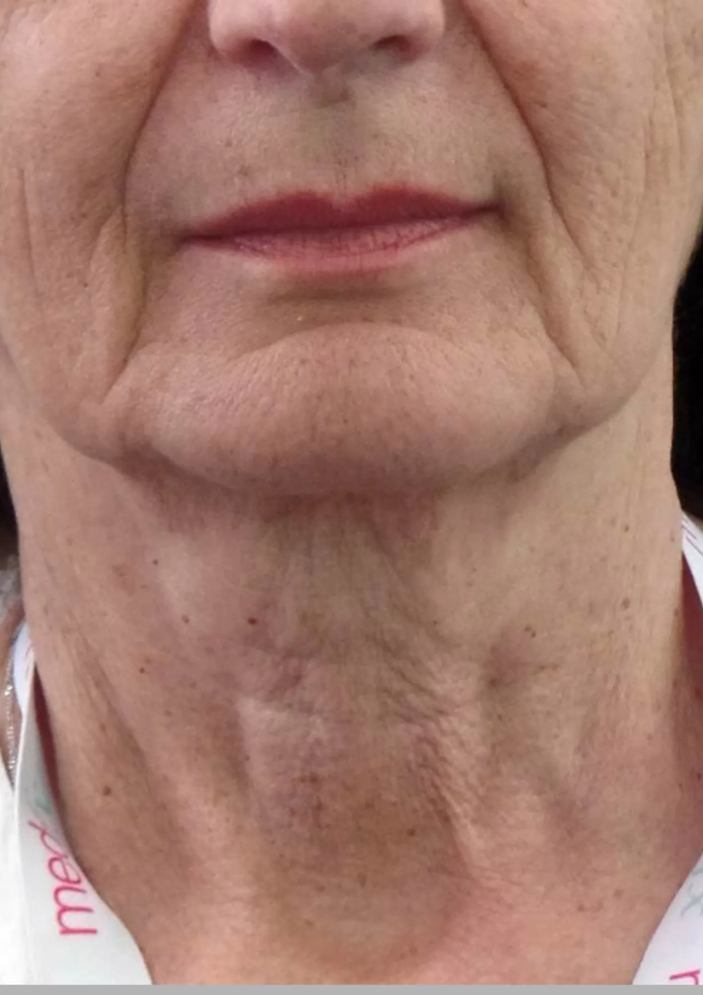 Before skin tightening treatment at Dental & Wellness London, Islington