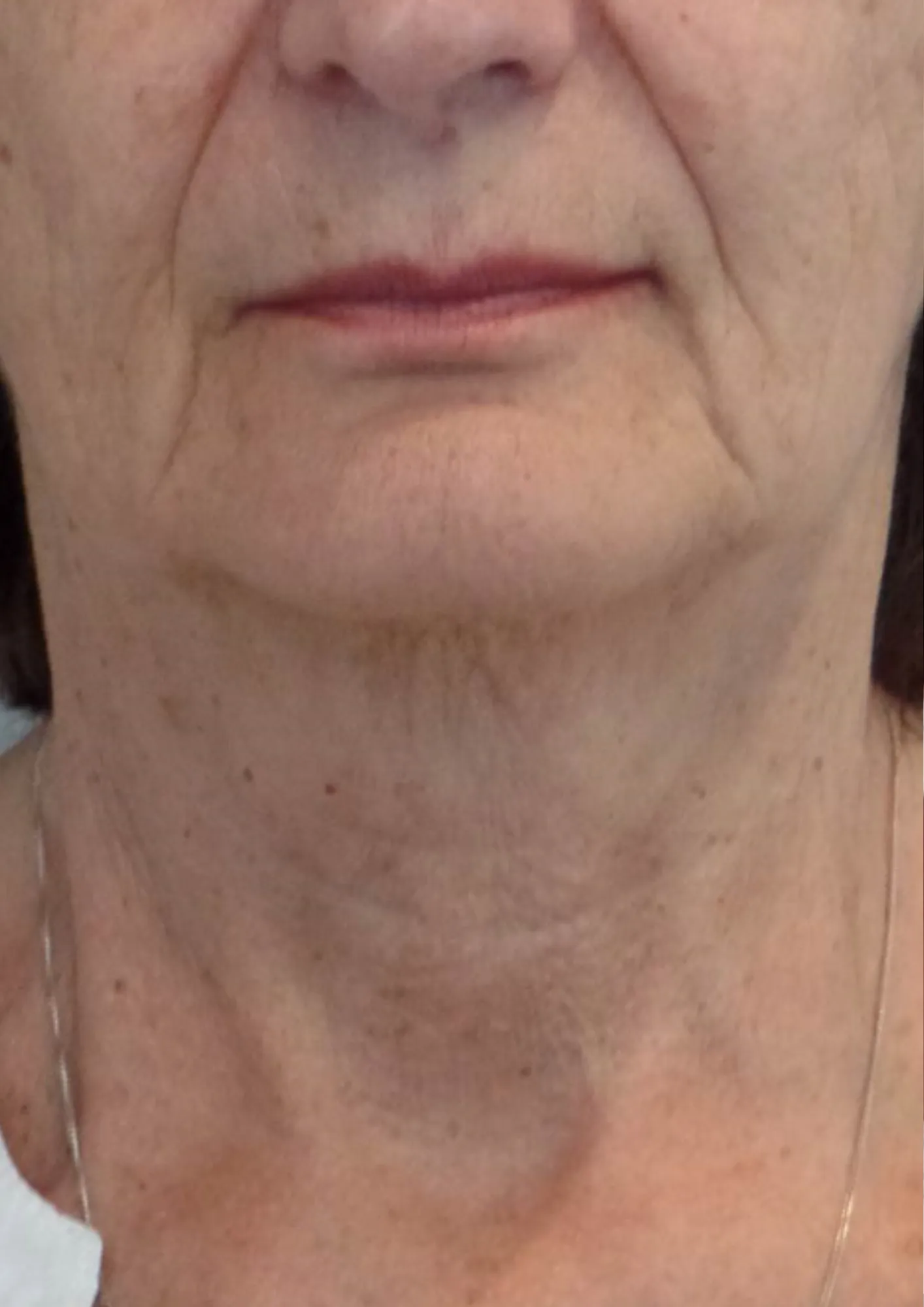 After skin tightening treatment at Dental & Wellness London, Islington