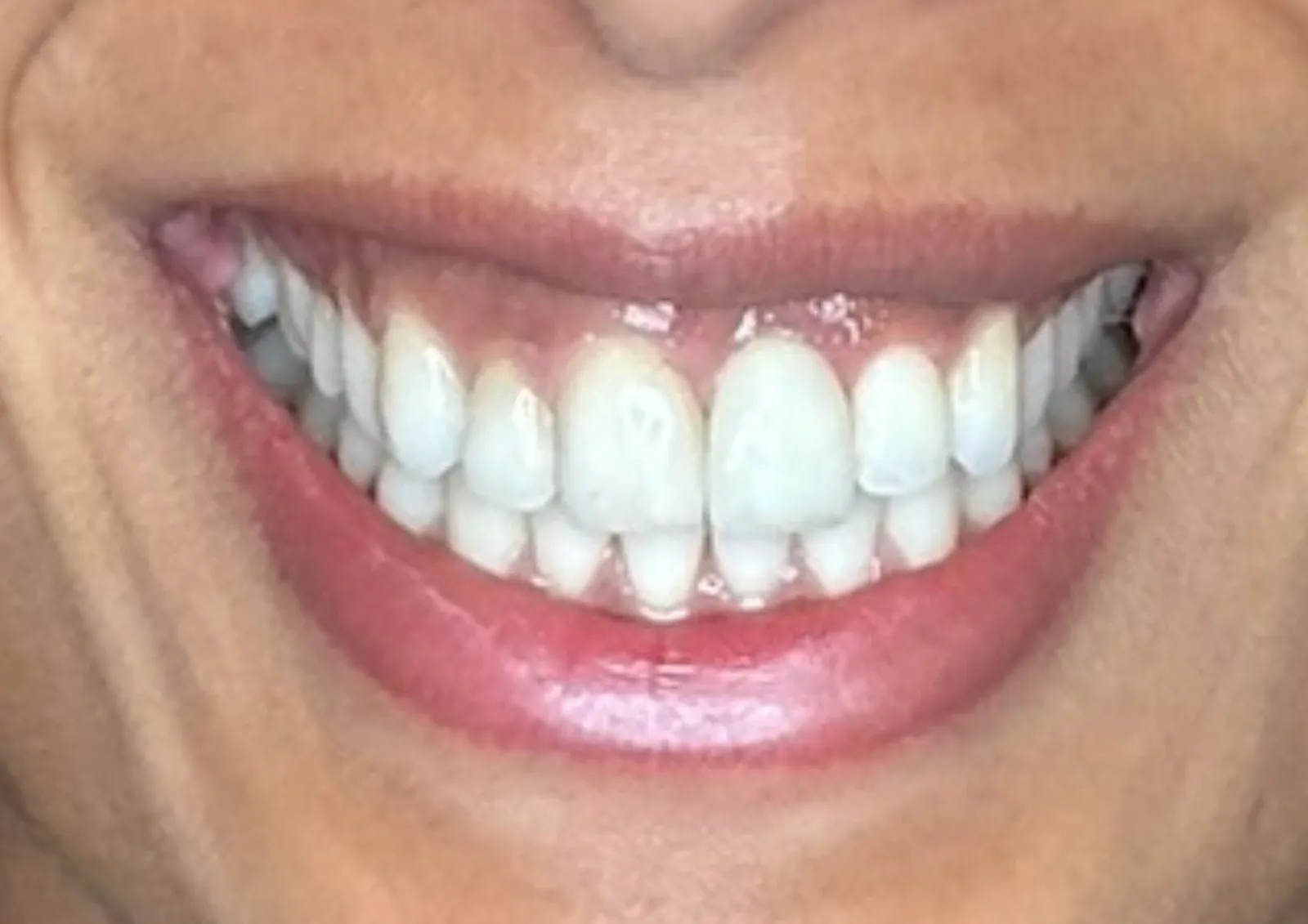 Before gummy smile treatment at Dental & Wellness London, Islington