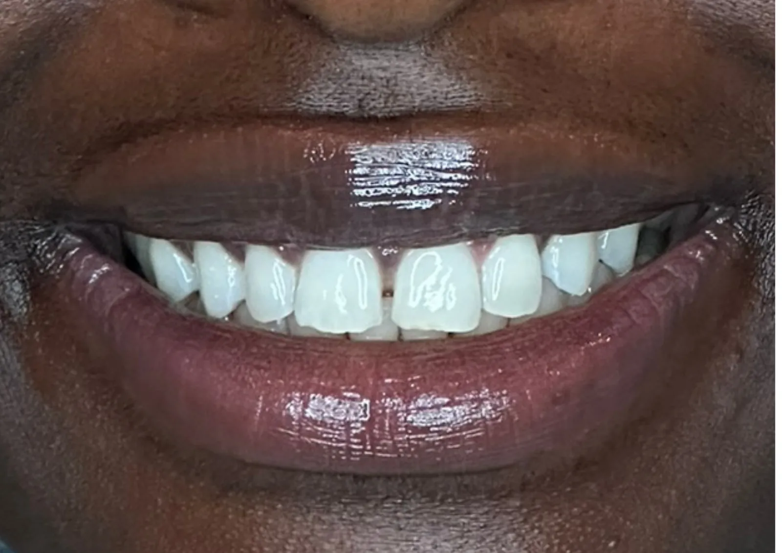 Before gappy teeth treatment at Dental & Wellness London, Islington