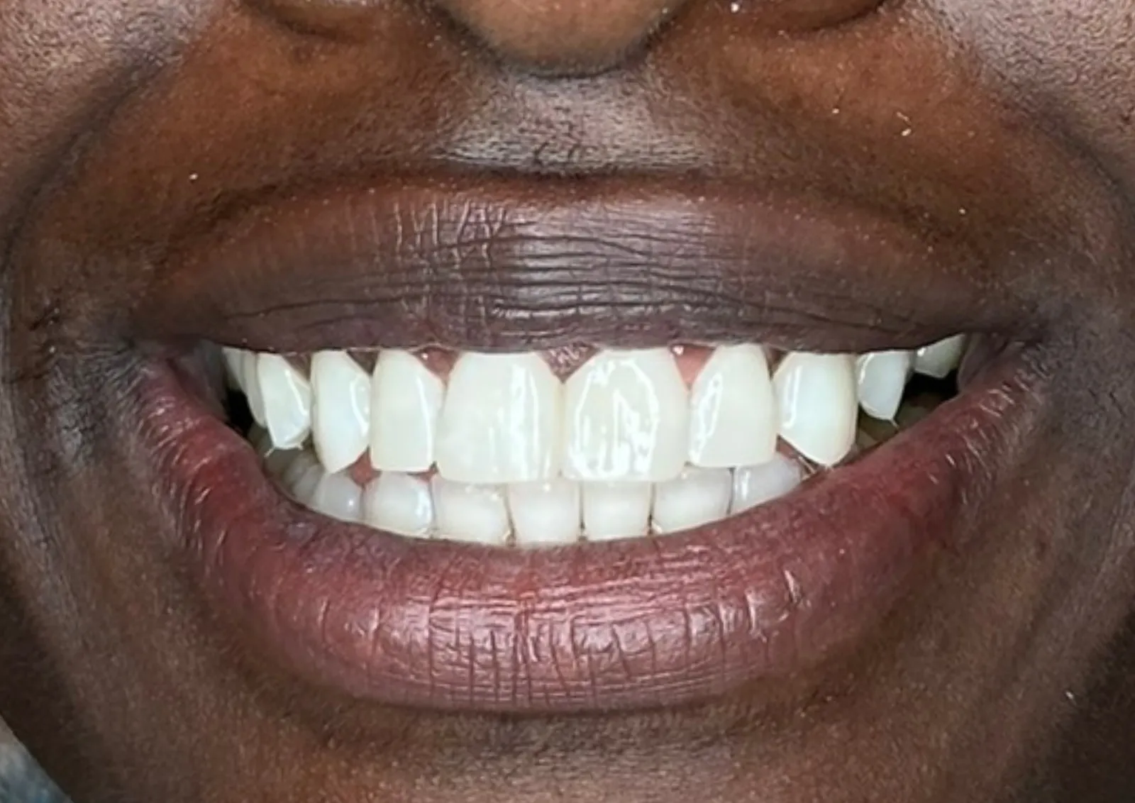 After gappy teeth treatment at Dental & Wellness London, Islington