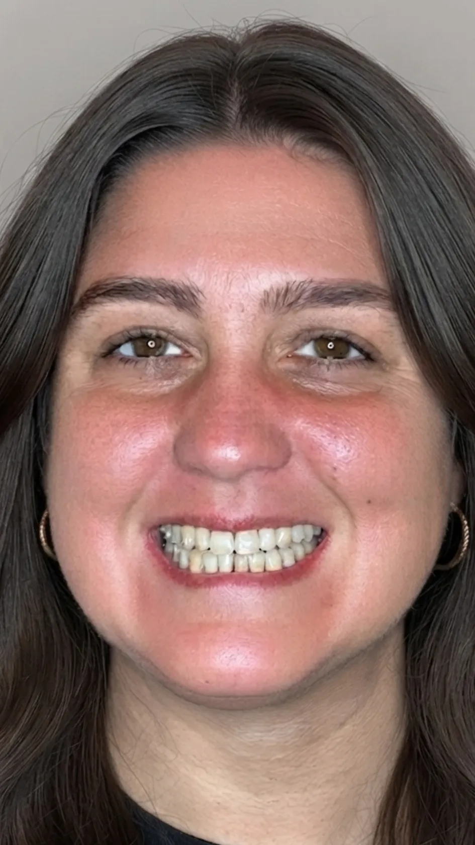 Before teeth whitening at Dental & Wellness London, Islington