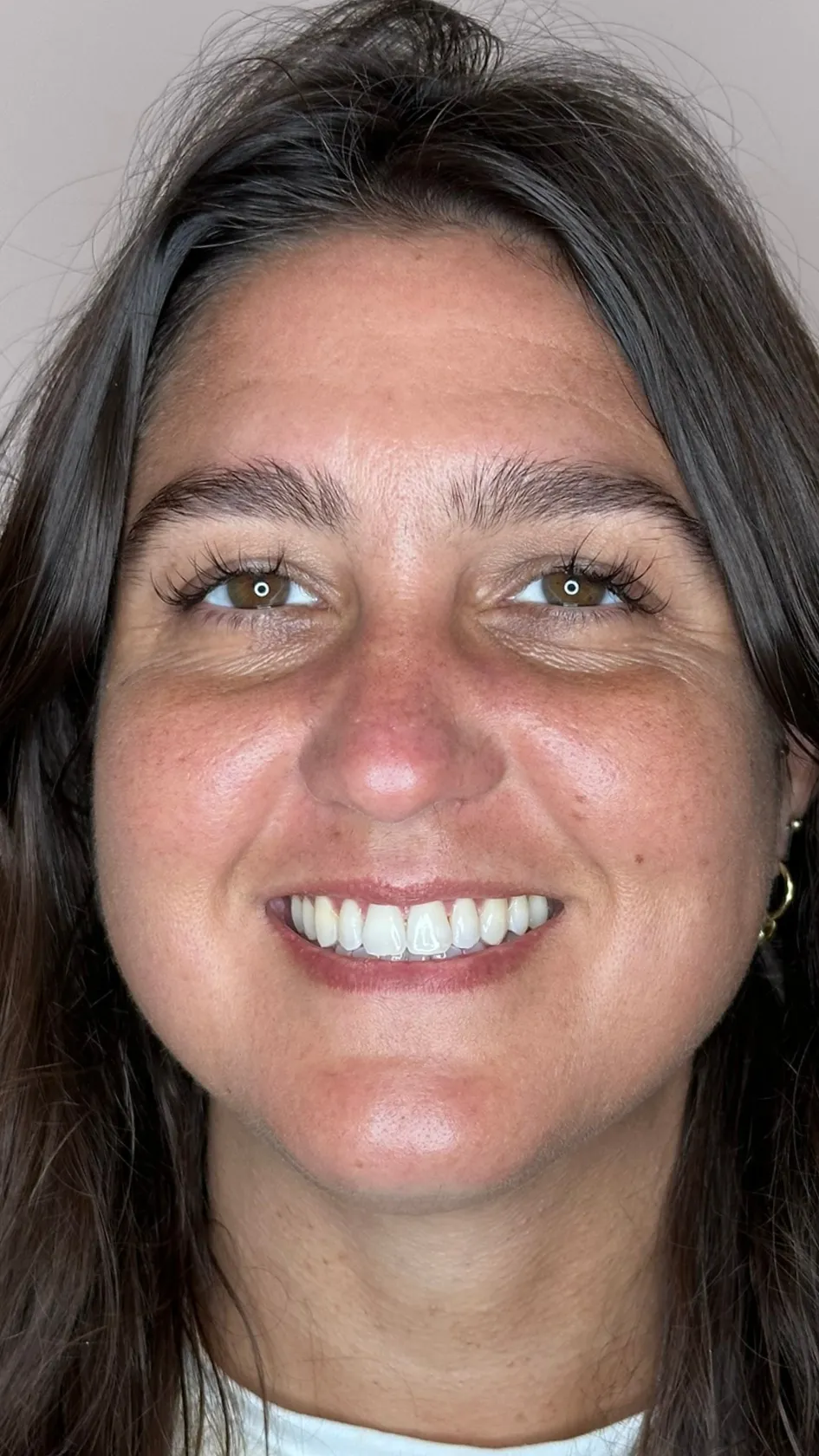 After teeth whitening at Dental & Wellness London, Islington