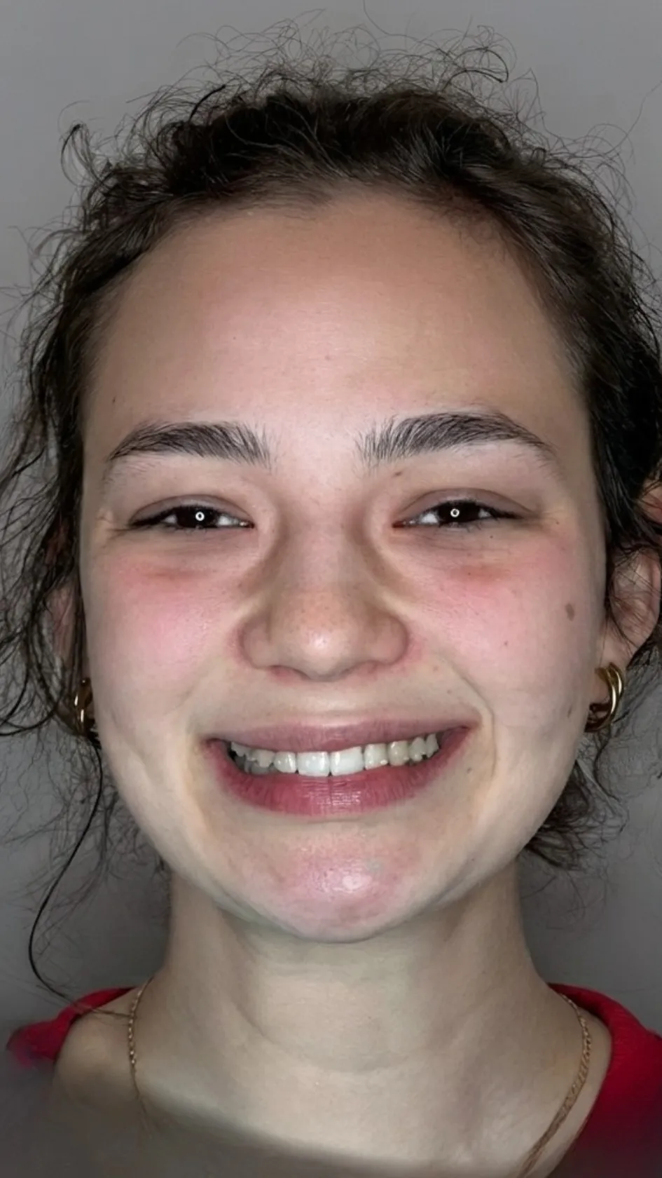 Before teeth whitening at Dental & Wellness London, Islington