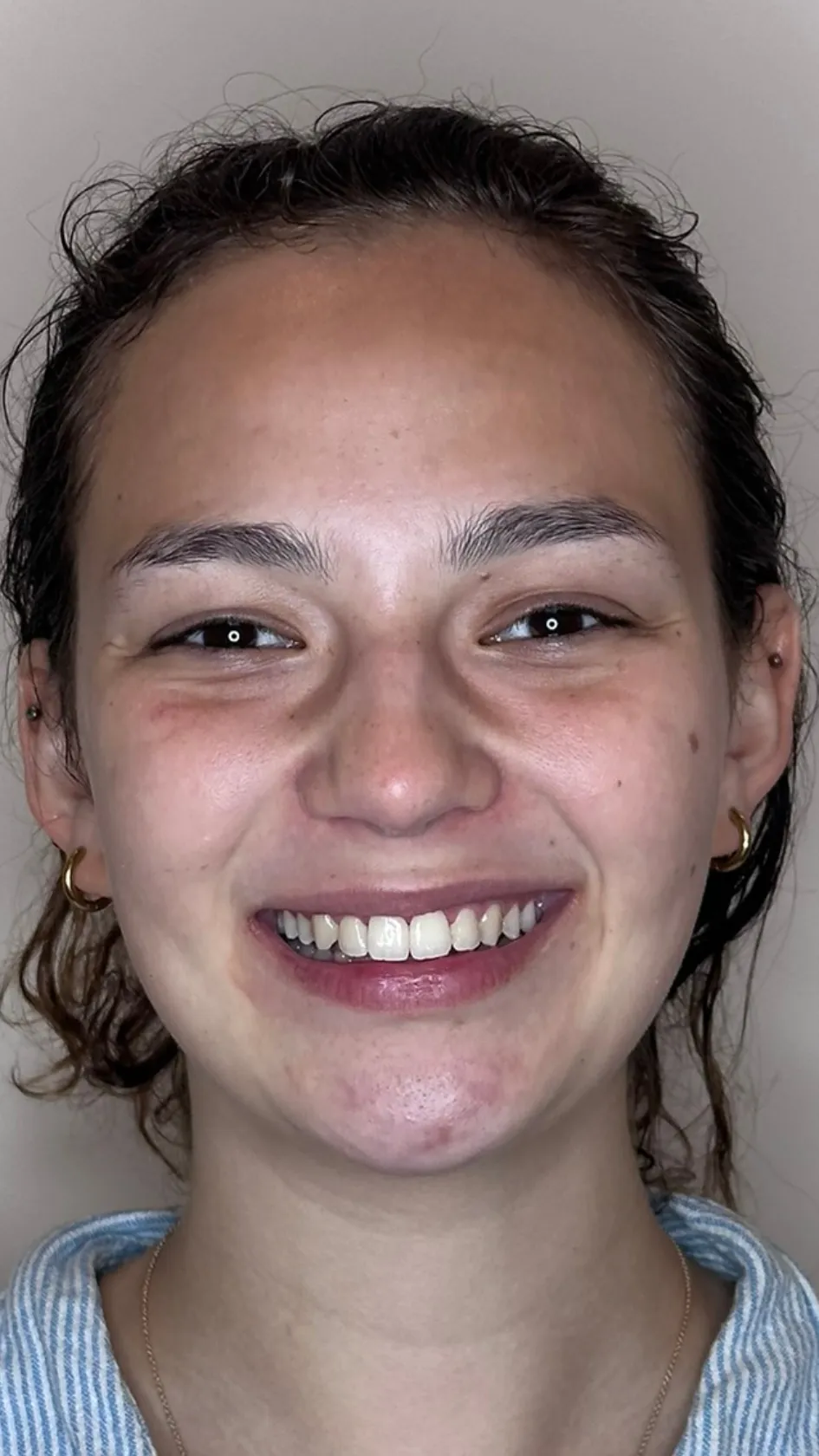 After teeth whitening at Dental & Wellness London, Islington