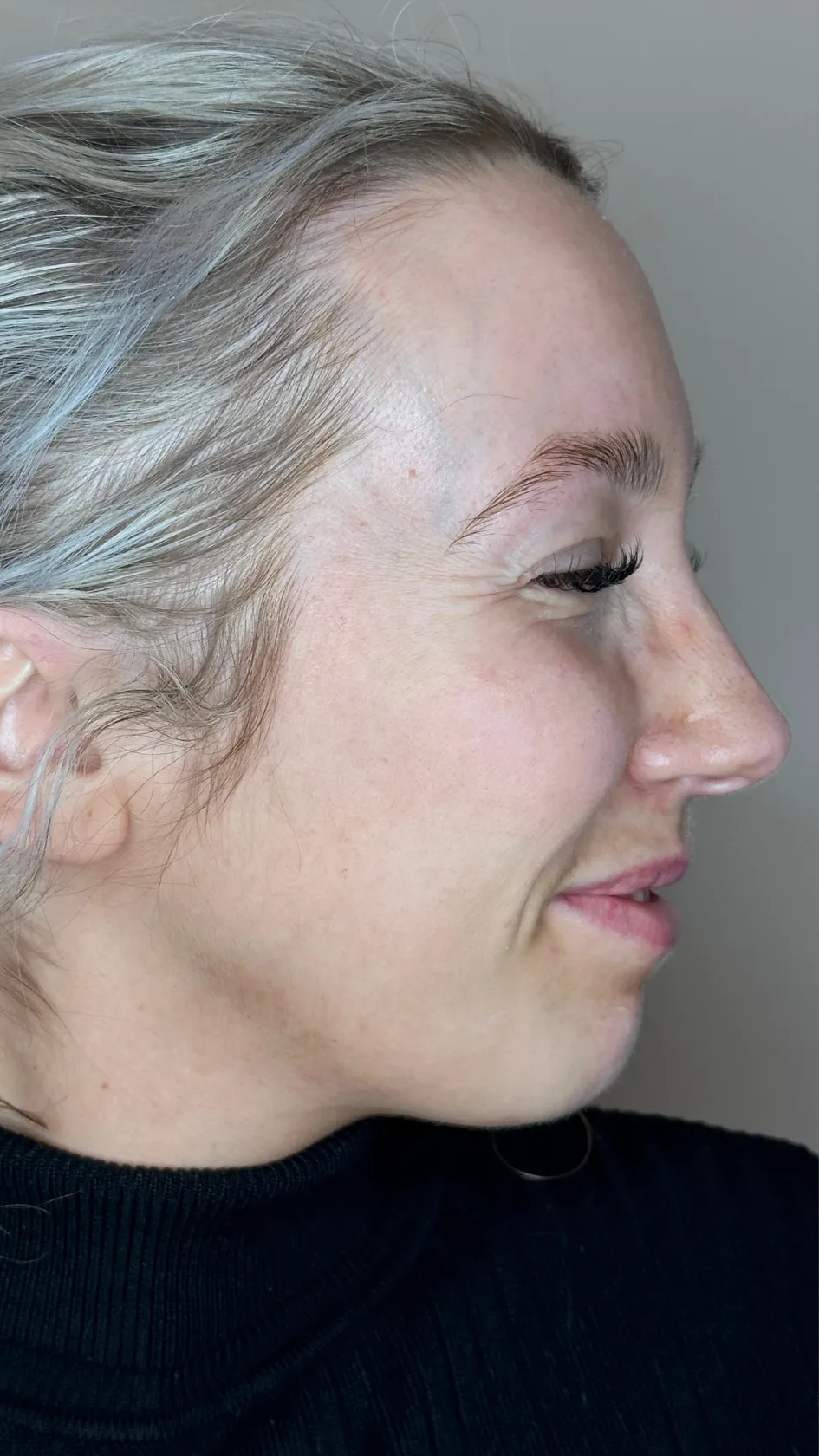 Before bunny lines treatment at Dental & Wellness London, Islington