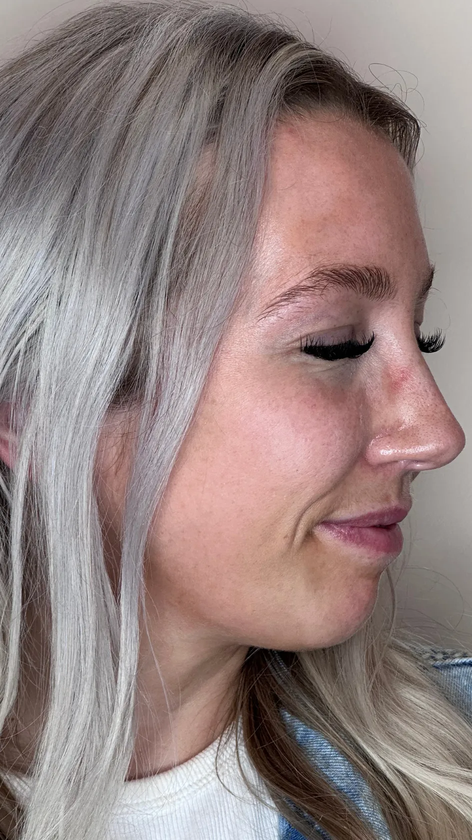 After bunny lines treatment at Dental & Wellness London, Islington
