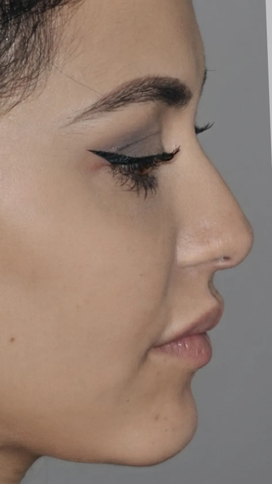 Before lip filler at Dental & Wellness London, Islington