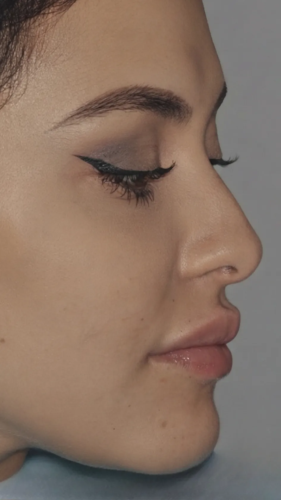 After lip filler at Dental & Wellness London, Islington