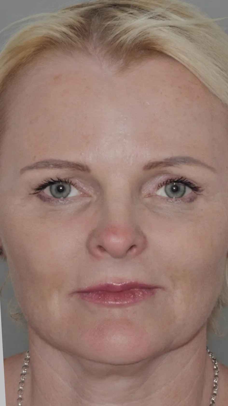After lip filler at Dental & Wellness London, Islington