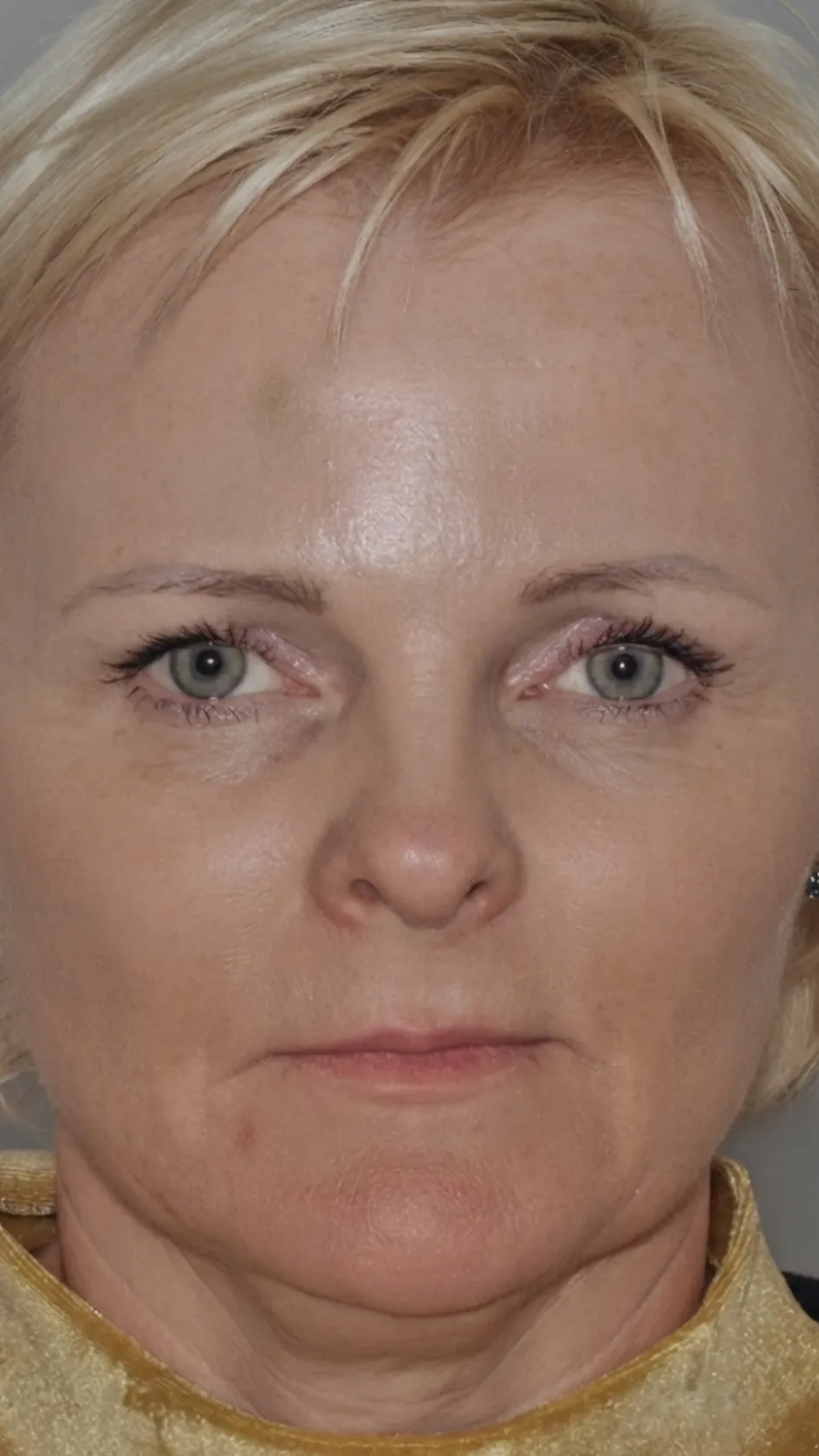 Before lip filler at Dental & Wellness London, Islington