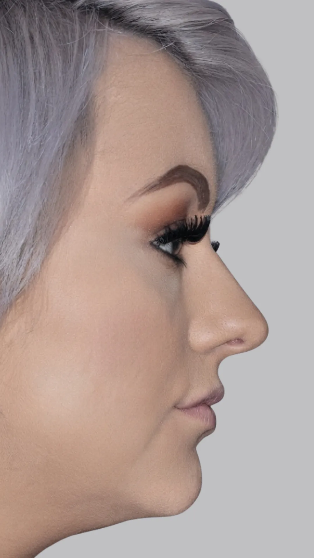 Before lip filler at Dental & Wellness London, Islington