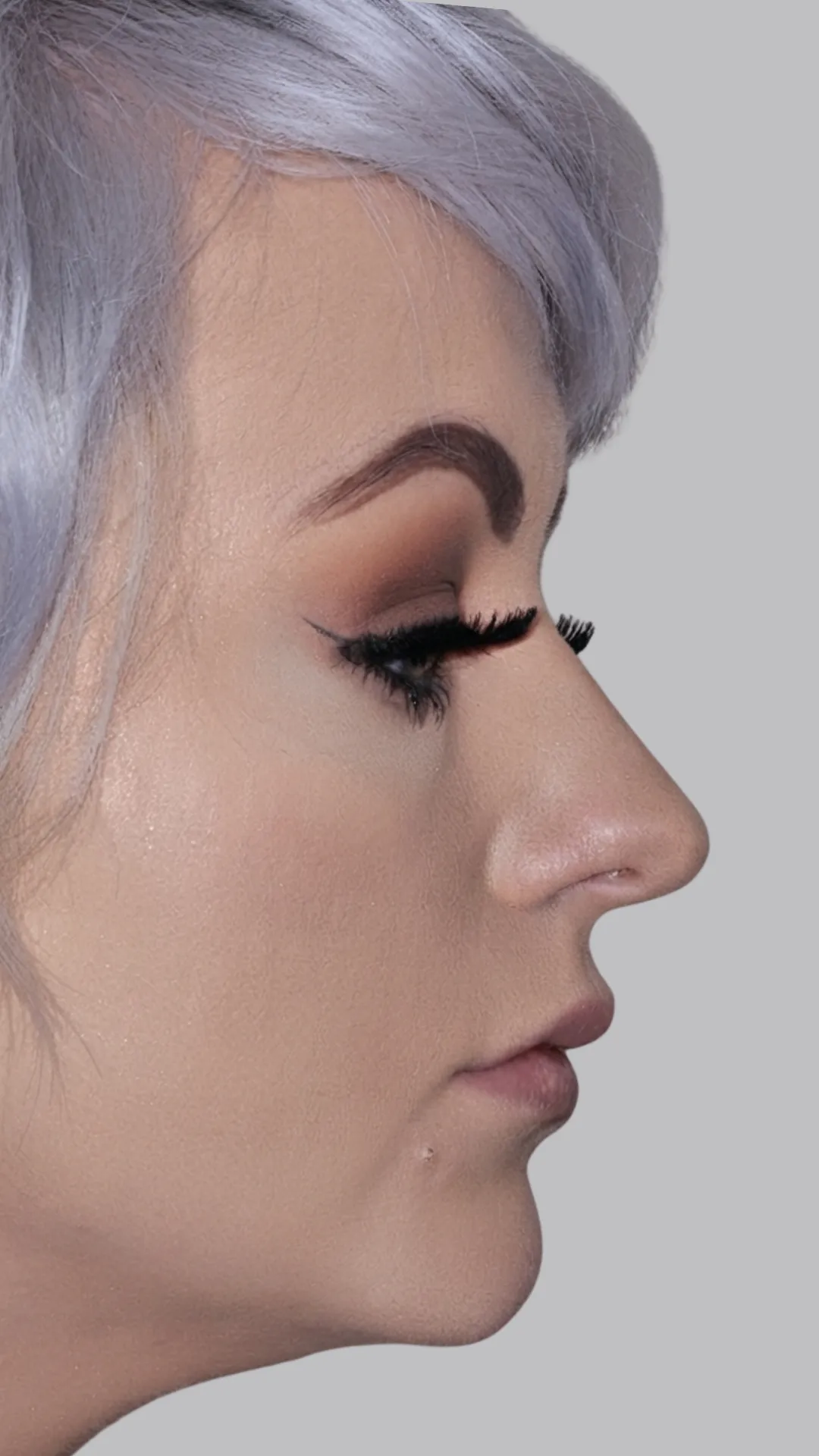 After lip filler at Dental & Wellness London, Islington