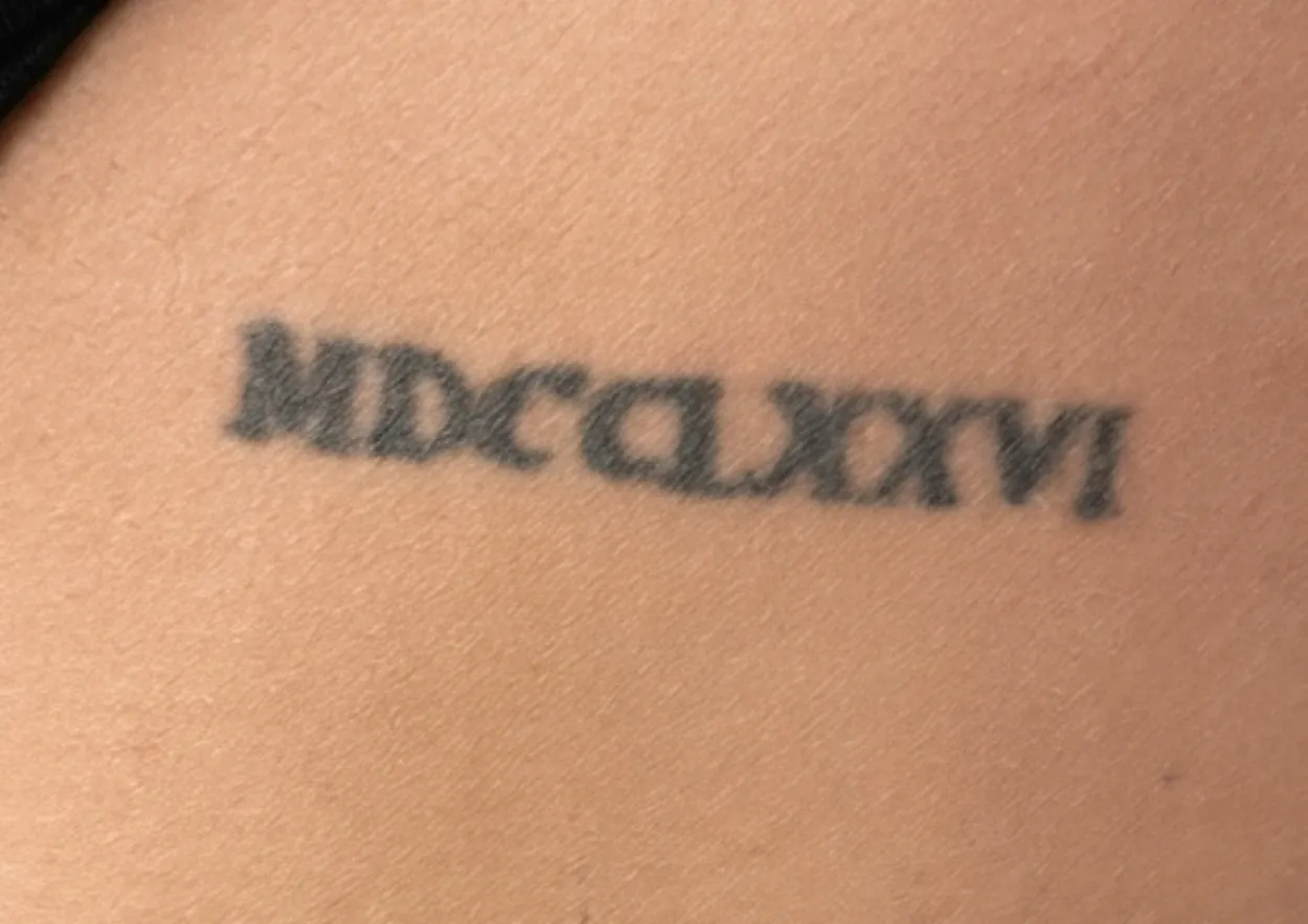 Before laser tattoo removal at Dental & Wellness London, Islington