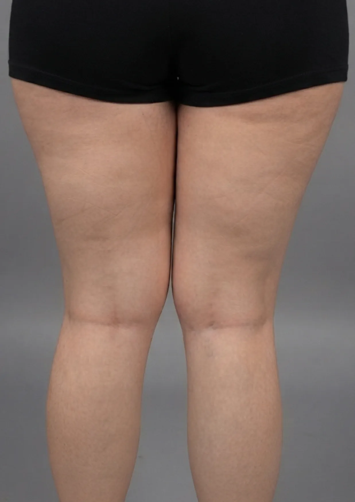 Before Onda body contouring at Dental & Wellness London, Islington