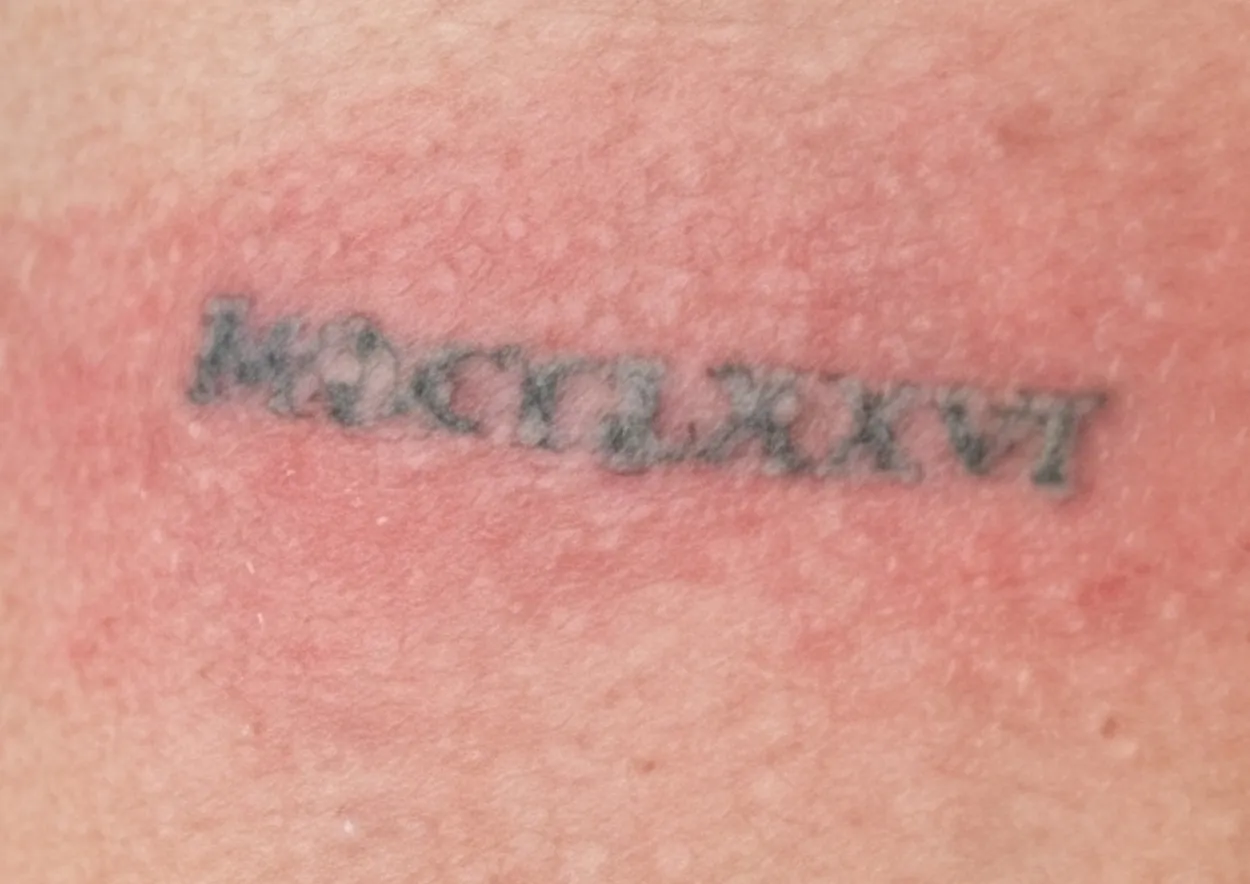 After laser tattoo removal at Dental & Wellness London, Islington