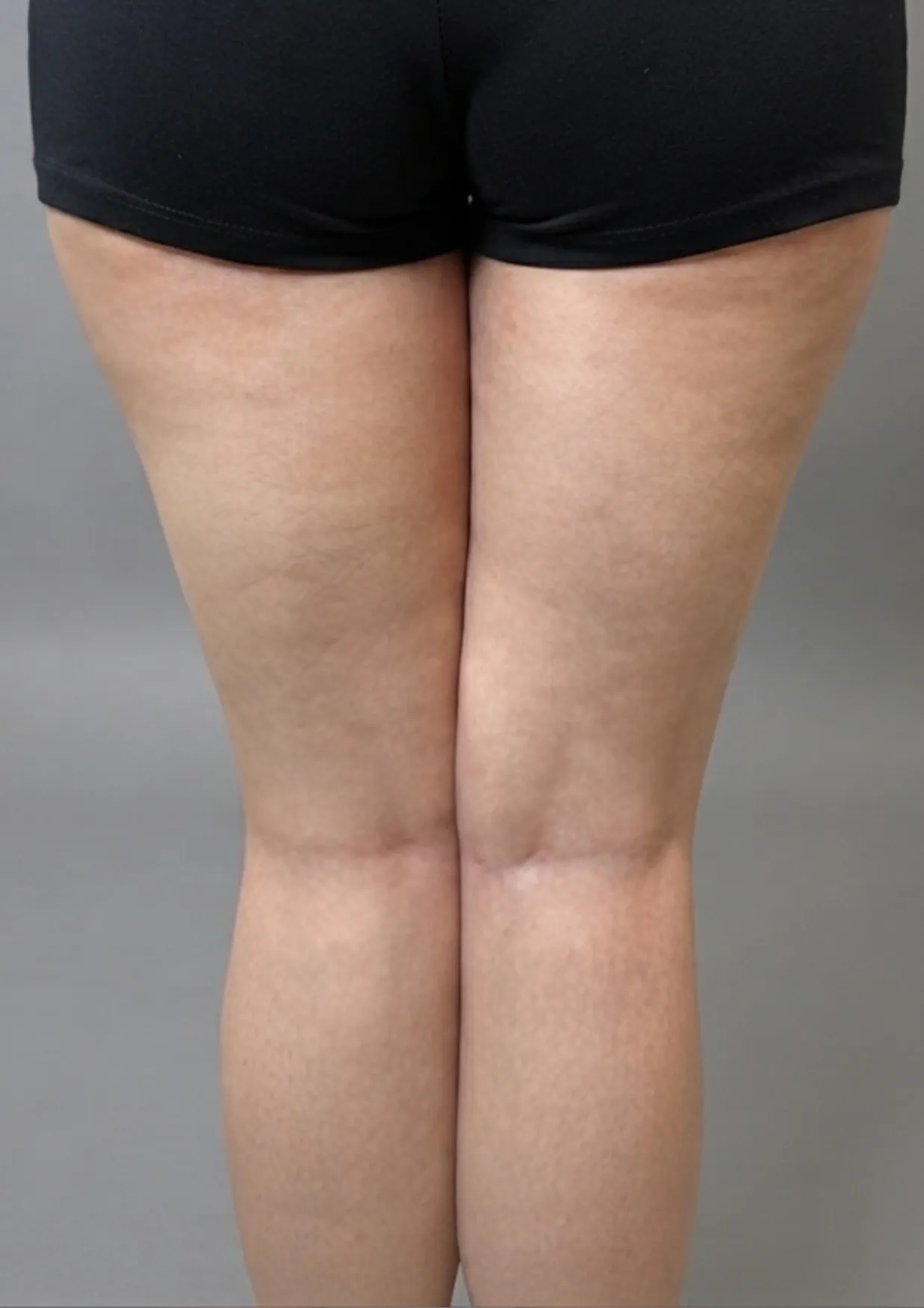 After Onda body contouring at Dental & Wellness London, Islington