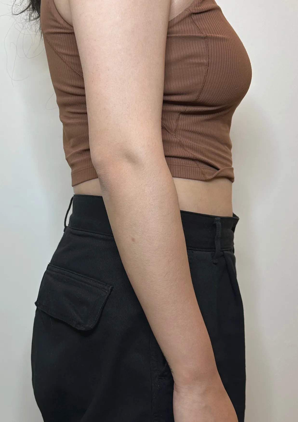 After Onda body contouring at Dental & Wellness London, Islington