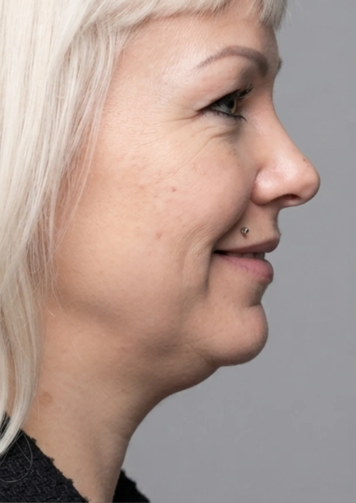 Before Onda body contouring at Dental & Wellness London, Islington