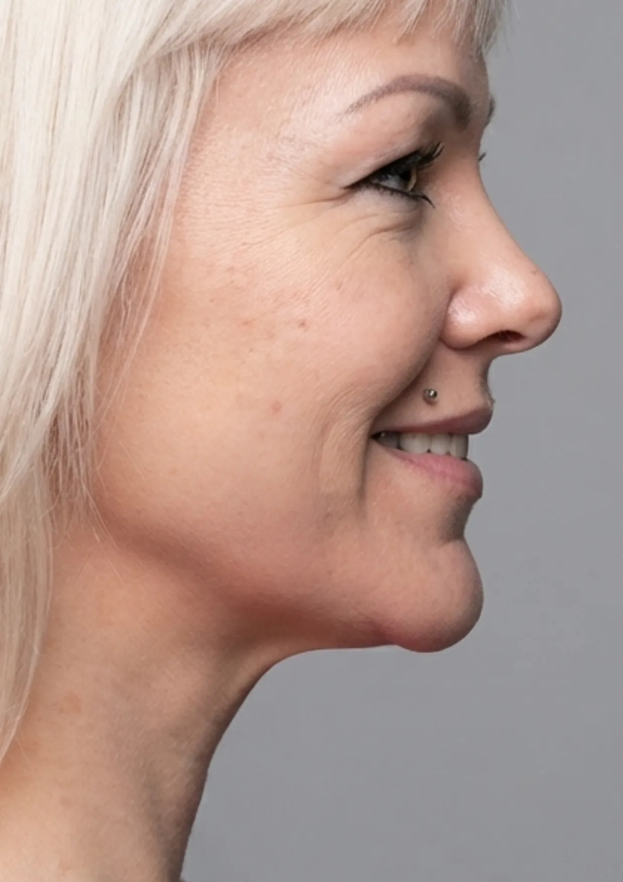 After Onda body contouring at Dental & Wellness London, Islington