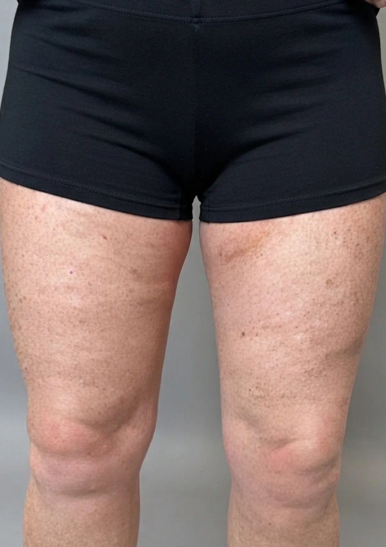 After Onda body contouring at Dental & Wellness London, Islington
